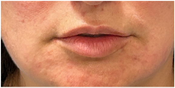 Lip Laser Plump before — Thin Lips, Perioral Aging, Lip Lines, Fine Lines, Wrinkles, front view