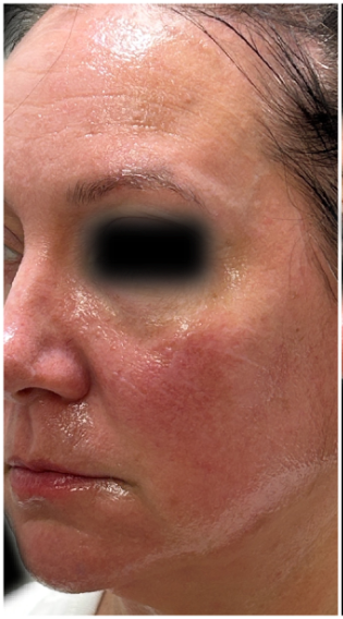 IPL Photofacial before — Facial Redness, Hyperpigmentation, Uneven Skin Tone, Sun Damage, front view