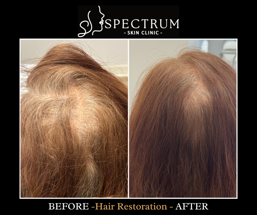 Exosome Therapy Before and After, Female Pattern Hair Density at Spectrum Skin Clinic, Irvine
