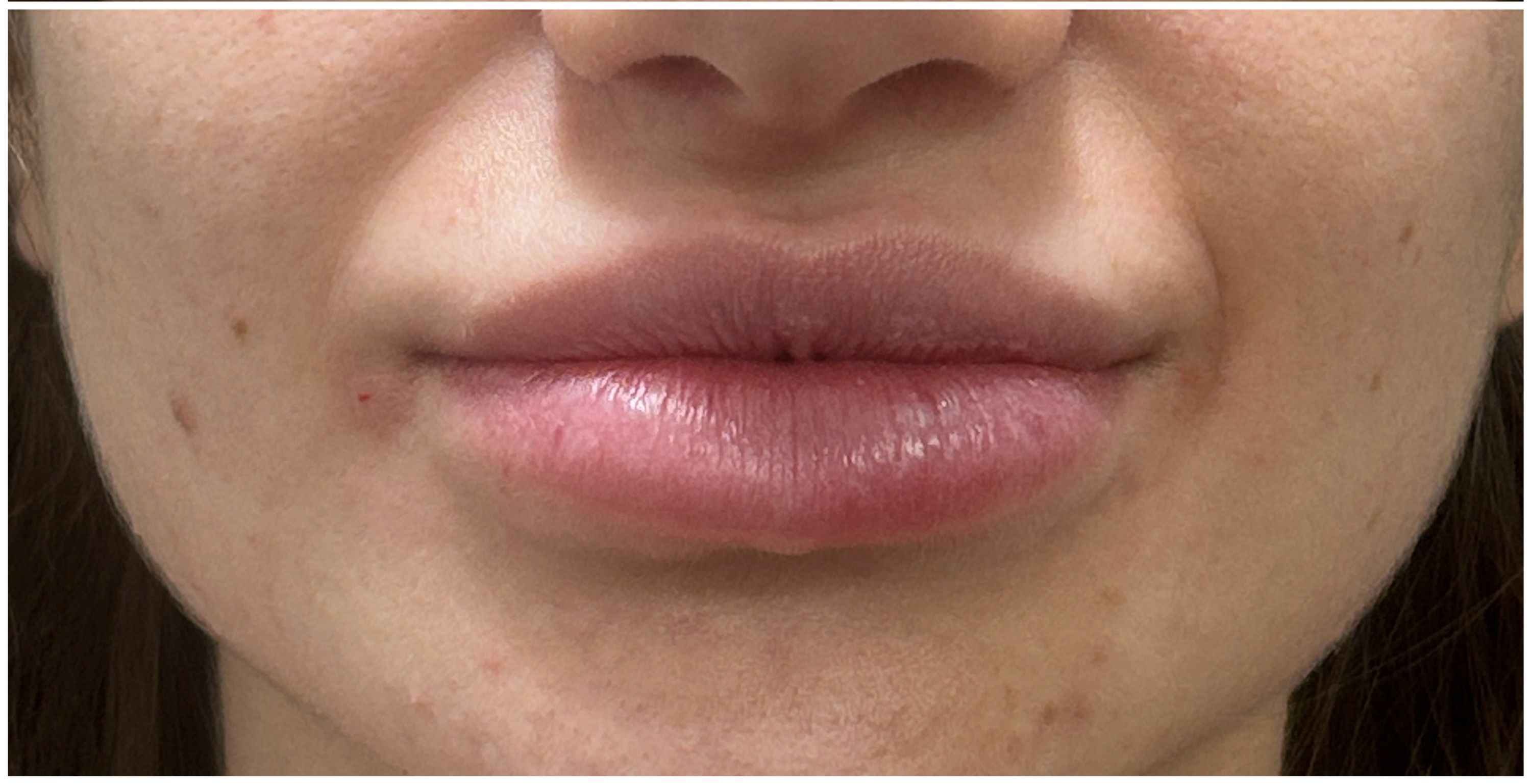 Lip Filler after — Thin Lips, front view