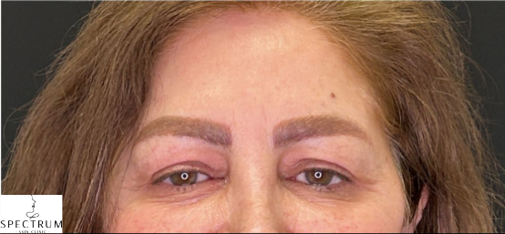 Botox after — Hooded Eyes, Low Brows, Forehead Heaviness, front view