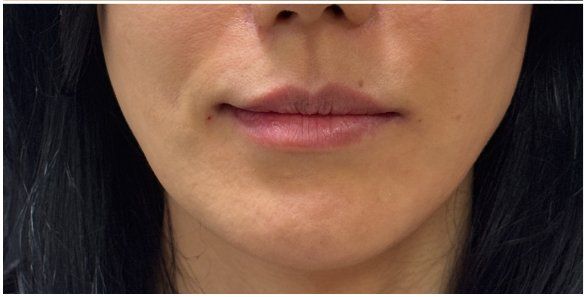 Lip Filler after — Thin Upper Lip, Lip Volume, Lip Definition, front view