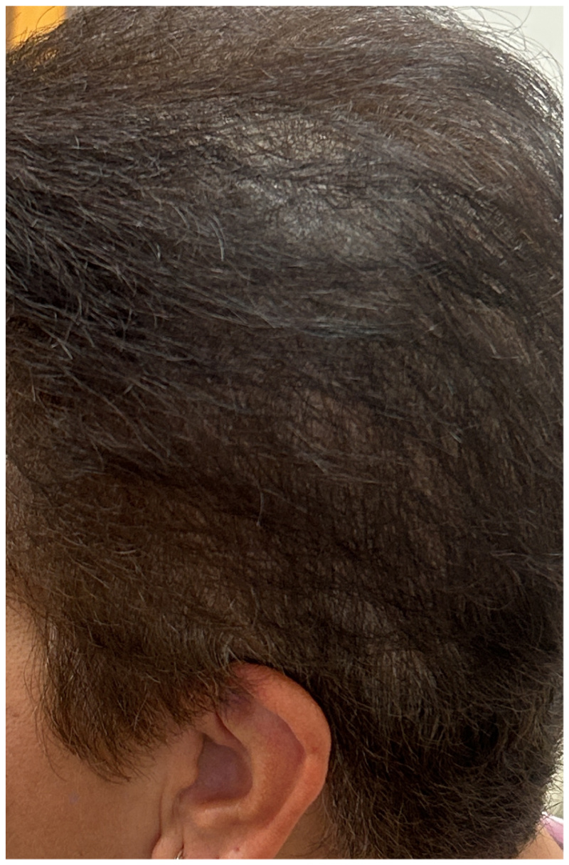 Exosome Therapy after — Female Pattern Hair Loss, Crown Density Loss, front view