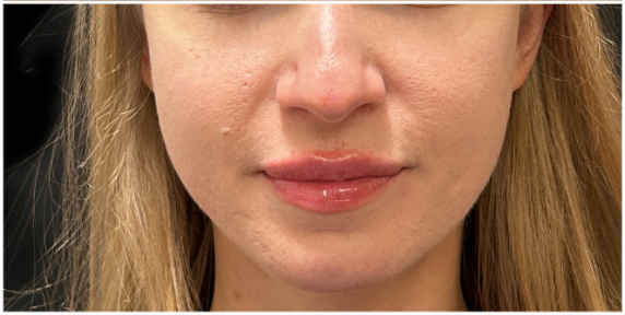 Masseter Botox after — Wide Jawline, front view