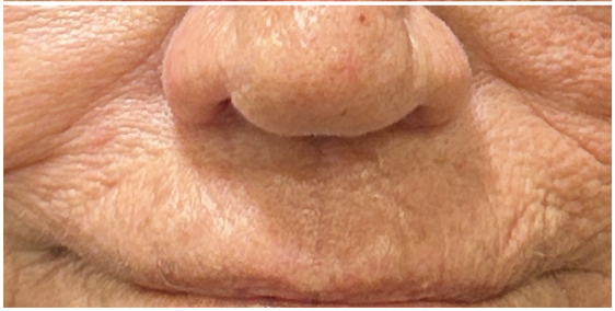 Lip Filler after — Thin Lips, Perioral Aging, Lip Lines, Fine Lines, Wrinkles, front view