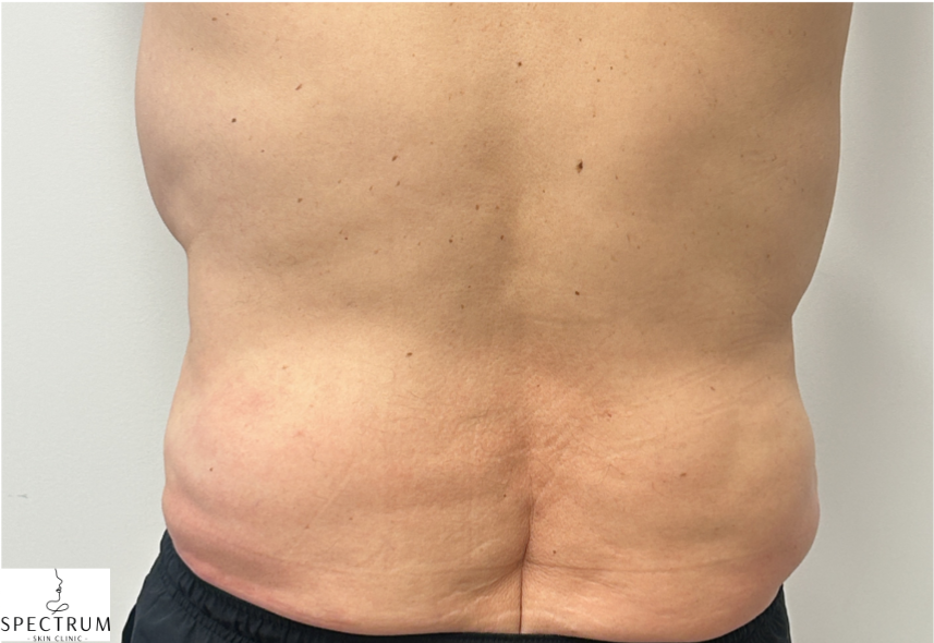 Body Cavitation after — Localized Fat, Body Contouring, Stubborn Fat Areas, front view