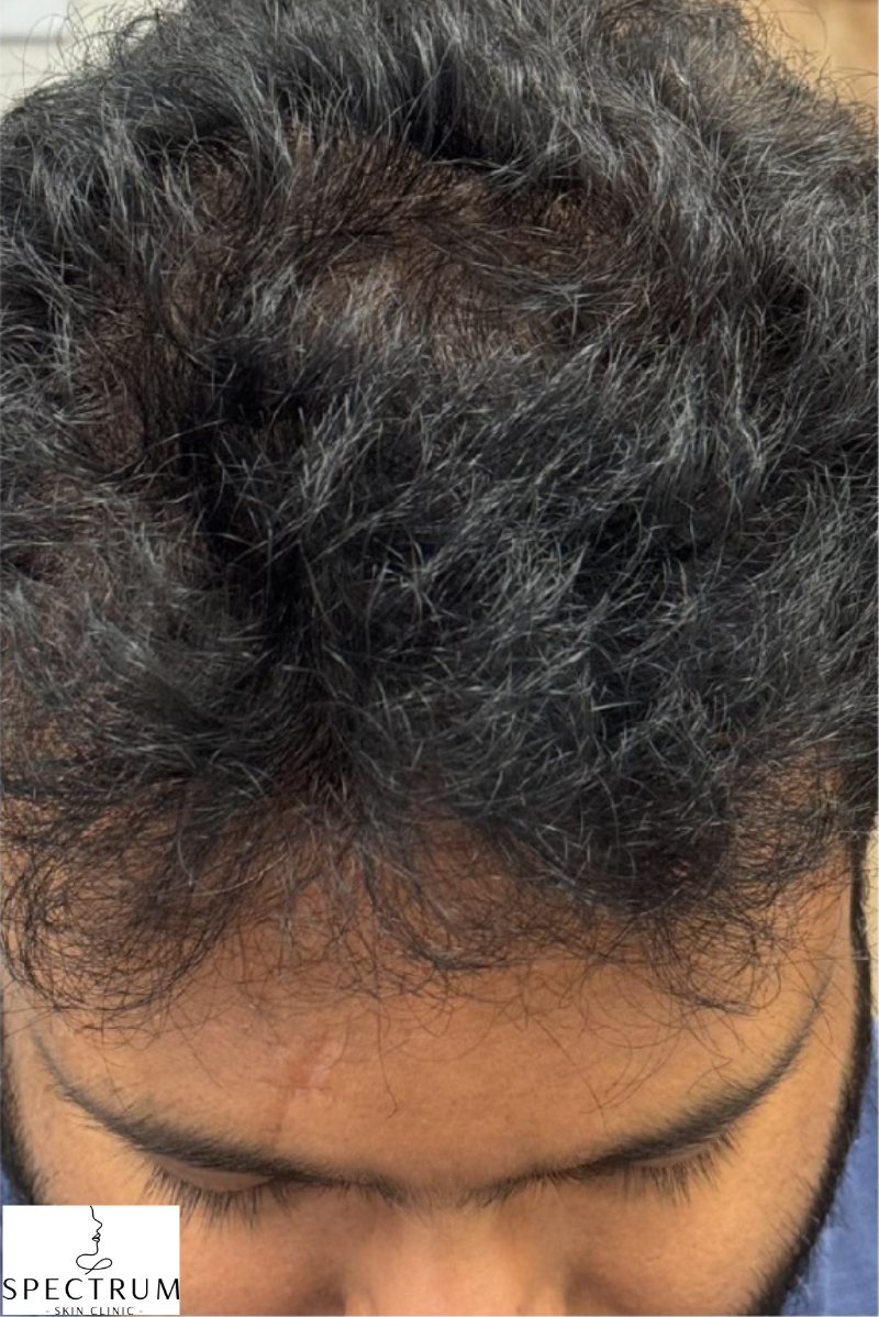 Exosome Therapy after — Thinning Crown, Visible Scalp, front view