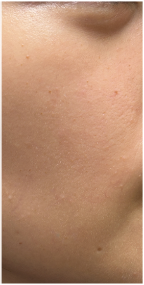 Laser Vein Removal after — Facial Veins, Telangiectasia, Localized Redness, Vascular Lesions, front view