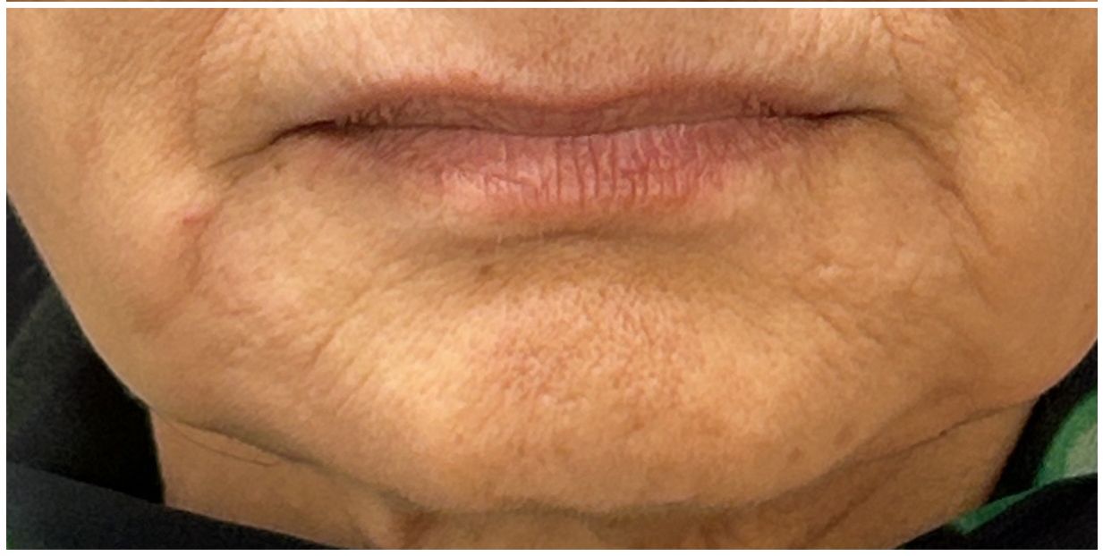Marionette Filler, Facial Balancing after — Marionette Lines, Lower Face Sagging, Lower Face Definition, front view