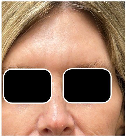CO2 Laser Resurfacing after — Forehead Lines, Uneven Skin Texture, Sun Damage, Redness, front view