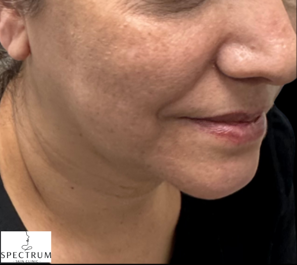 HIFU before — Sagging and Laxity, Lower Face Sagging, Jowling, front view