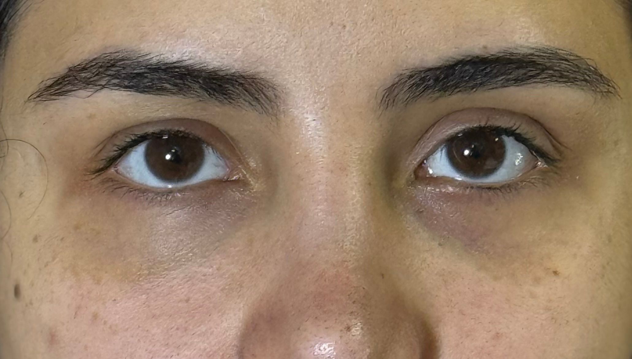 Under Eye Filler before — Under Eye Hollows, Dark Circles, Tear Trough, front view