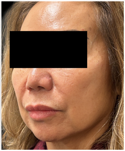 Cheek Filler, Facial Balancing, Restylane after — Midface Volume Loss, Nasolabial Folds, Lower Face Sagging, front view