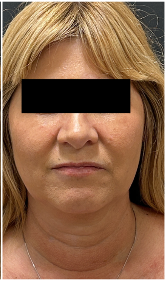 eMatrix + IPL after — Photodamage, Skin Laxity, Uneven Skin Texture, front view