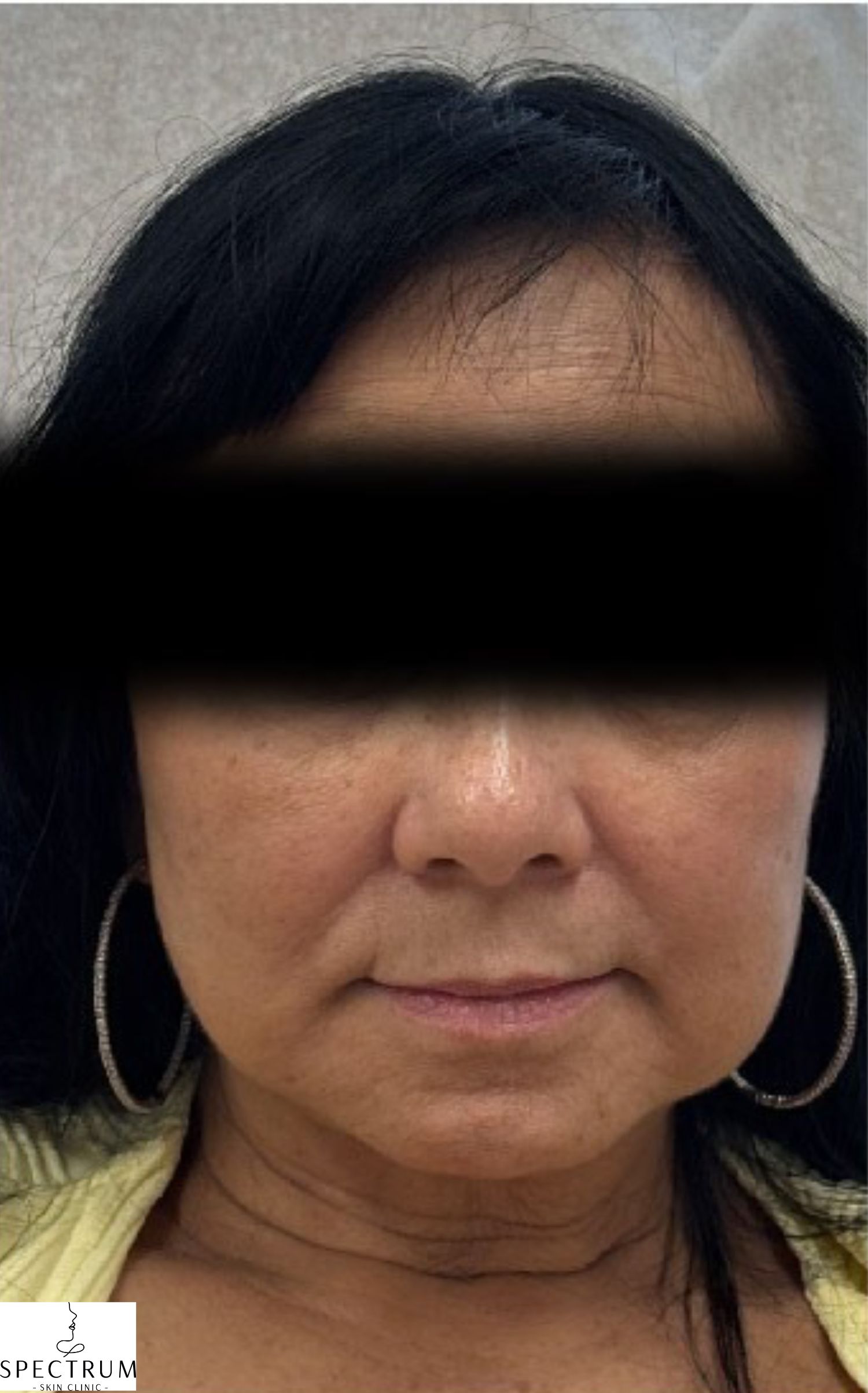 IPL Photofacial after — Sun Damage, Hyperpigmentation, Uneven Skin Tone, Facial Redness, Visible Vessels, front view