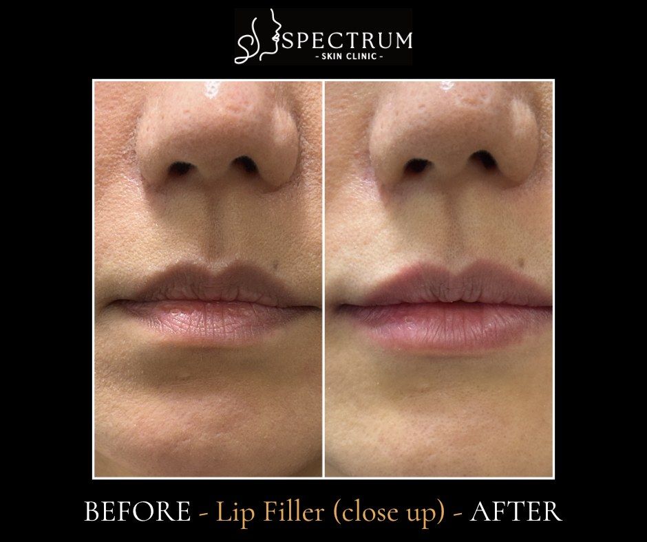 Lip Filler Before & After | Close-Up Border and Surface