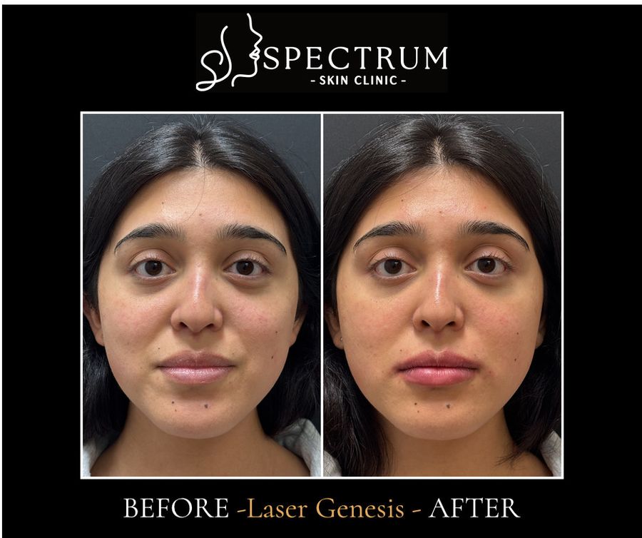 Laser Genesis Before & After | Calmer Redness and More Even Tone