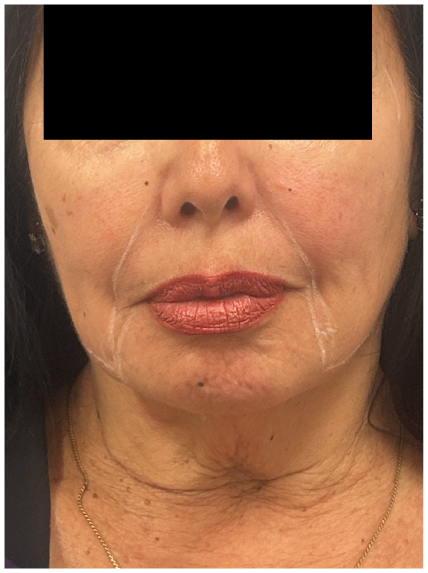 Nefertiti Botox before — Jawline Blurring, Lower Face Sagging, Neck Band Activity, Loss of Lower-Face Definition, front view