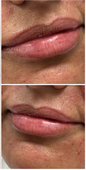 Lip Filler after — Perioral Aging, Lip Lines, Uneven Texture, front view