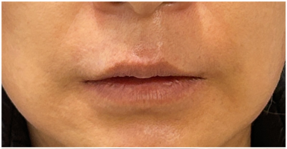 Lip Filler before — Lip Asymmetry, front view