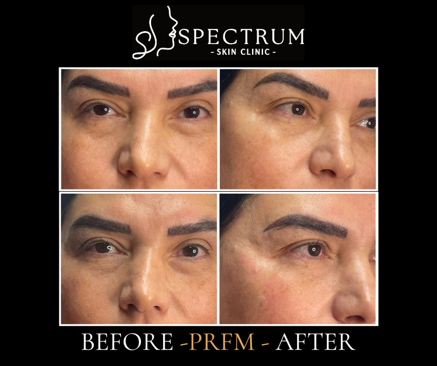 PRFM Under Eye Before & After | Natural Volume and Skin Quality in a Mature Patient