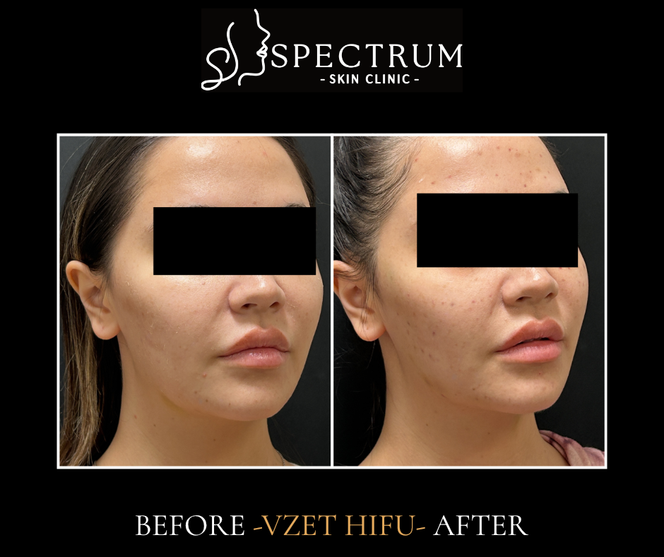 HIFU Before & After | Jawline Definition and Lower-Face Lift