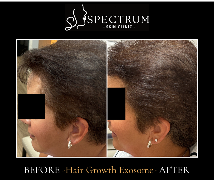 Exosome Therapy Before and After, Hair Density and Scalp Coverage at Spectrum Skin Clinic, Irvine