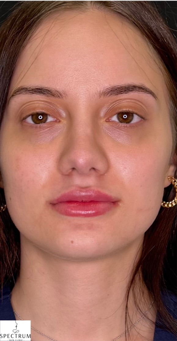 Lip Filler after — Volume and Definition, front view