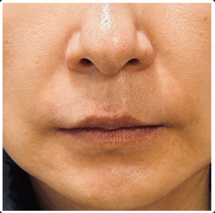Lip Filler before — Thin Lips, front view