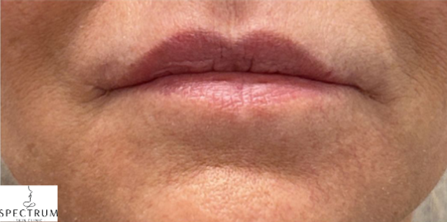 Lip Filler Before and After | Thin Lips with Perioral Fine Lines — before