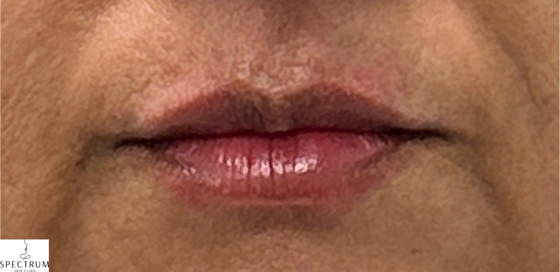 Lip Filler after — Volume Loss, front view