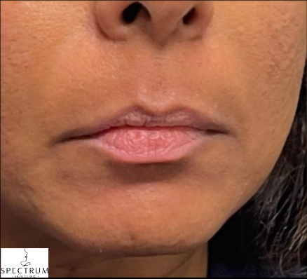 Lip Flip before — Flat upper lip and minimal lip show, front view