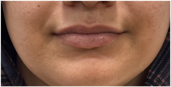 Lip Filler before — Thin Lips, front view
