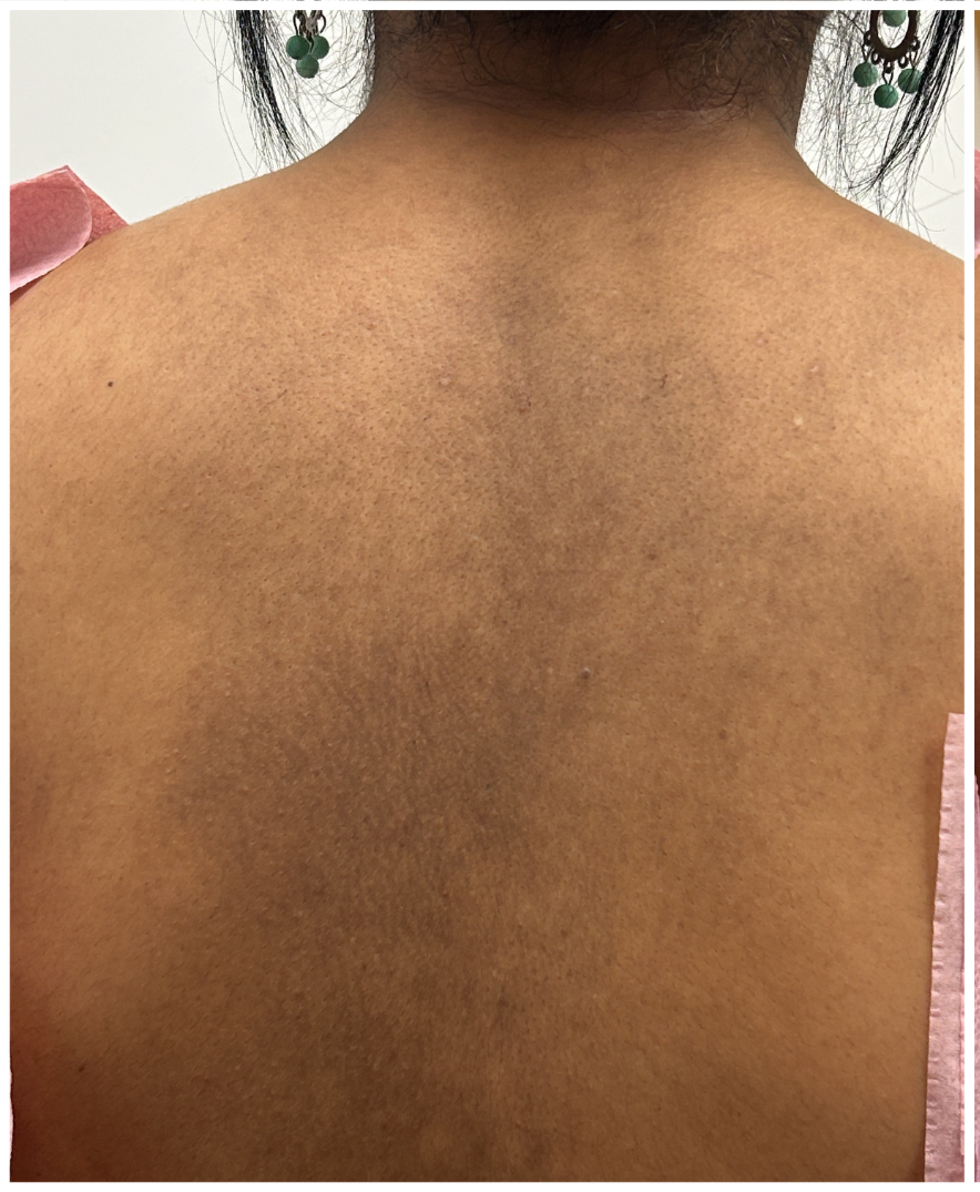 Pico Laser before — Hyperpigmentation, Sun Damage, Post-Inflammatory Hyperpigmentation, front view