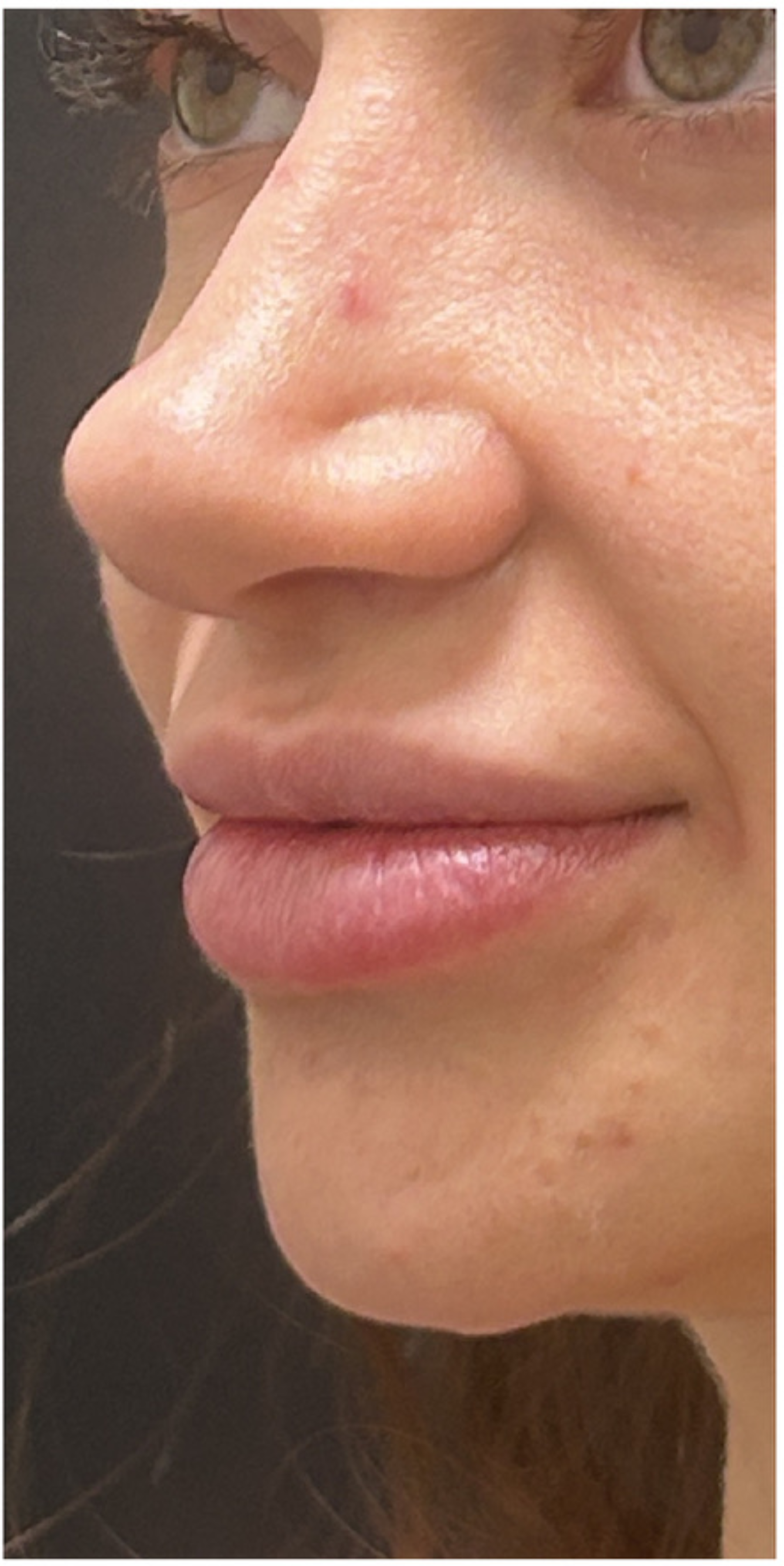 Lip Filler after — Volume and Definition, front view
