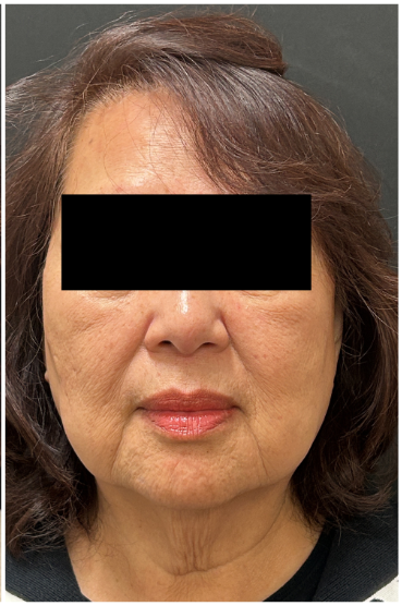 Secret PRO after — Uneven Texture, Fine Lines and Wrinkles, Enlarged Pores, Sagging and Laxity, front view