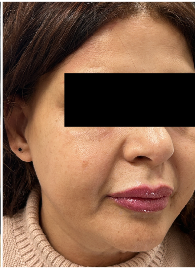 eMatrix Sublative RF Resurfacing after — Sagging and Laxity, Fine Lines and Wrinkles, Loss of Firmness, front view
