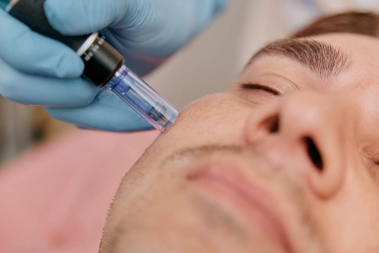 Bilde av en mann som får dermapen behandling