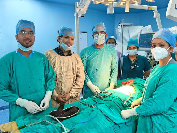 शिवपुरी मेडिकल कॉलेज में डॉक्टरों का कमाल, 14 साल की किशोरी के पेट से निकाला बालों का बड़ा गुच्छा