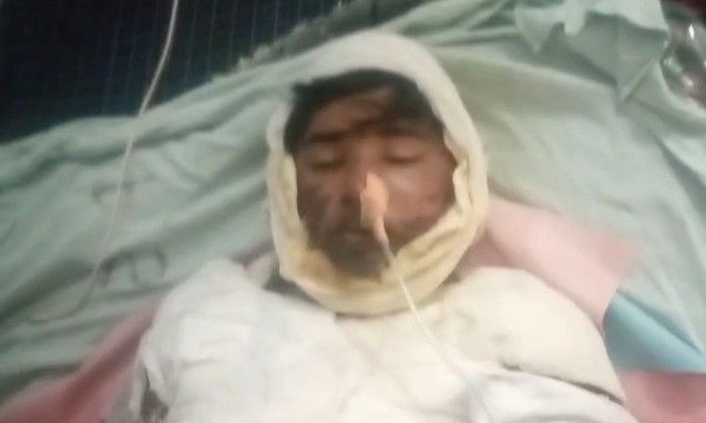 शिवपुरी में कबाड़ा समेटते वक्त करंट की चपेट में आया किशोर, 70 फीसदी झुलसने के बाद ग्वालियर रेफर