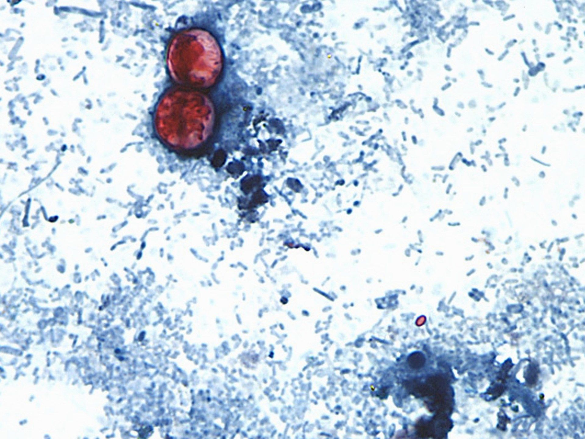 The Unseen Toll of a Parasite: Behind the US Cyclospora Outbreak