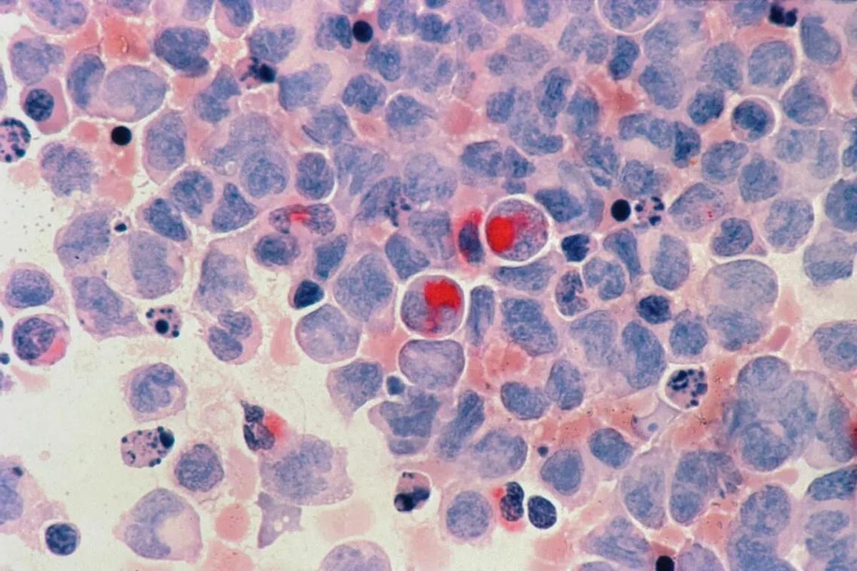 Covid-19 Pandemic's Hidden Toll: 55,000 Undiagnosed Cancer Cases Across 7 Nations