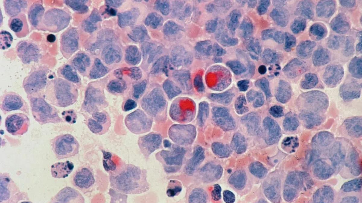 Covid-19 Pandemic's Hidden Toll: 55,000 Undiagnosed Cancer Cases Across 7 Nations