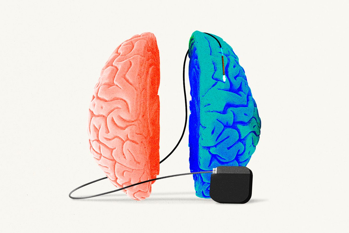 Open split brain with stimulator device.