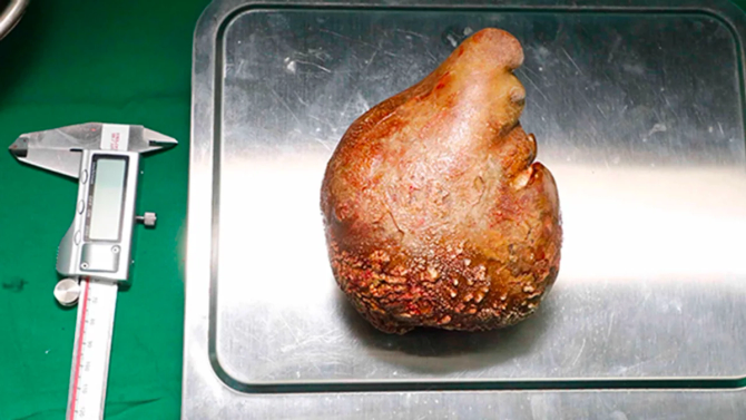 The world's largest kidney stone