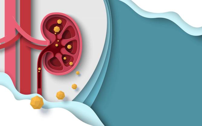 A graphic of kidney stones.