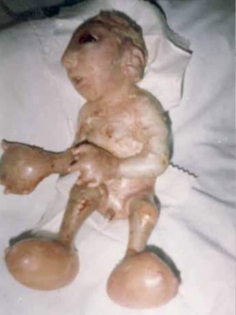 NH #621:  Depleted Uranium Weapons = Nuclear War in Ukraine - Dr. Helen Caldicott