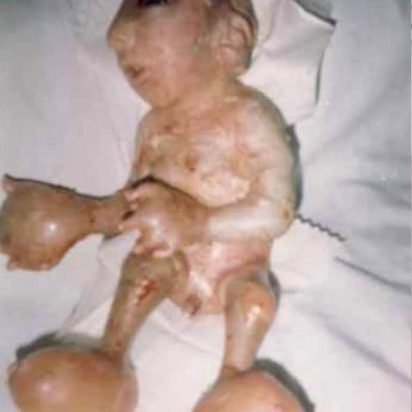NH #621: Depleted Uranium Weapons = Nuclear War in Ukraine - Dr. Helen Caldicott