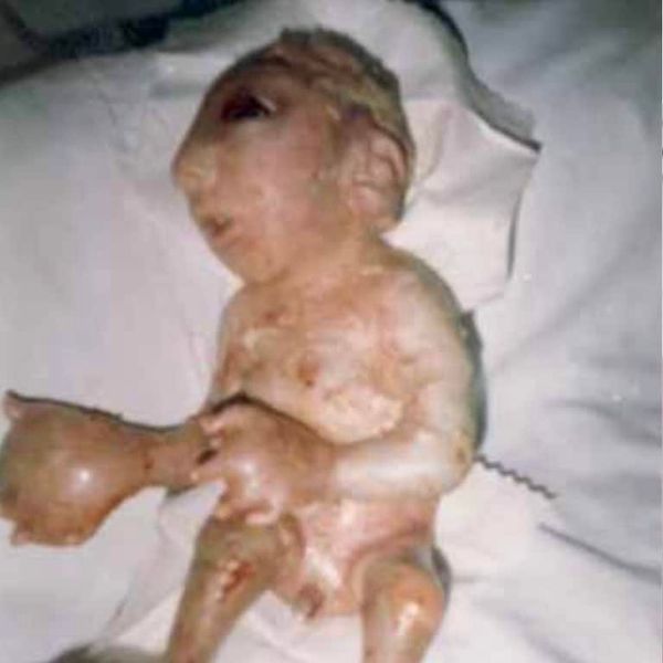 NH #621: Depleted Uranium Weapons = Nuclear War in Ukraine - Dr. Helen Caldicott