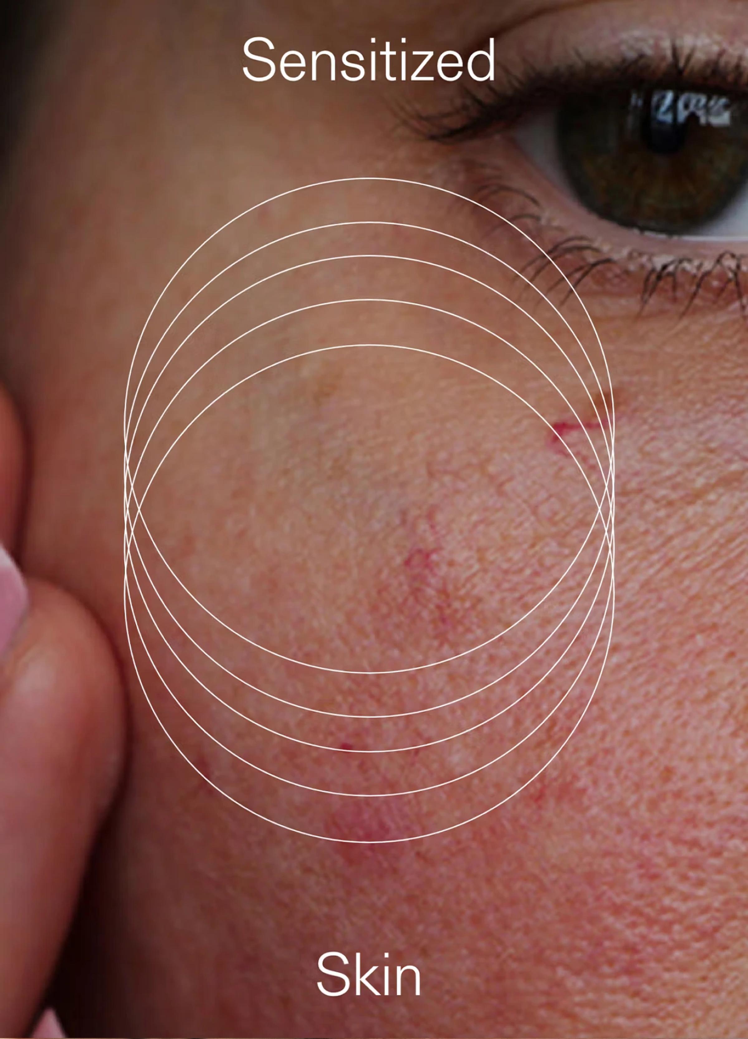 Close-up of sensitive skin showing redness and uneven texture, with text overlay labeling it as "Sensitized Skin."